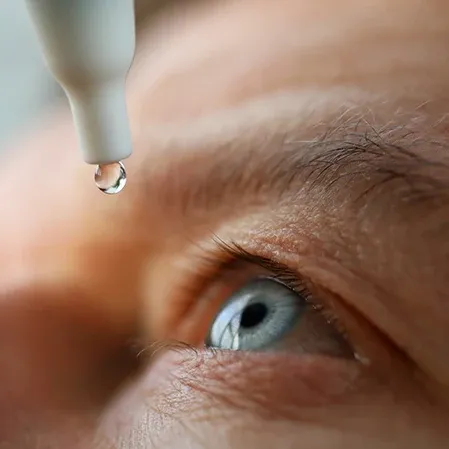 A precise application of eye drops near the eye area, suggesting an ophthalmic or therapeutic procedure.
