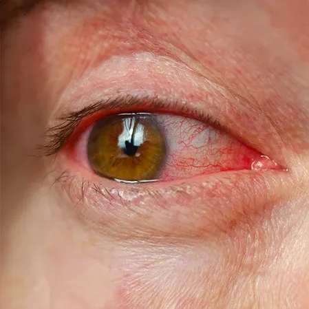 The image is showing a close-up of an irritated eye with redness.
